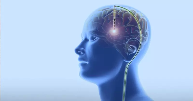 جراحی تحریک عمقی مغز چیست؟