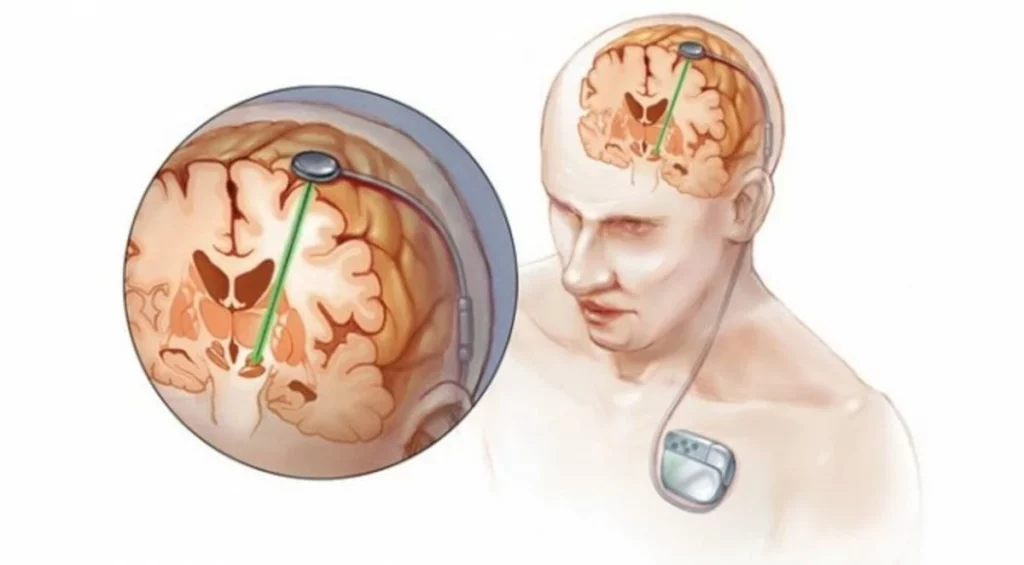 عوارض جراحی عمیق مغزی