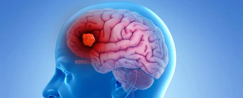 جراحی تومور مغزی