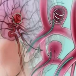 آنوریسم مغزی