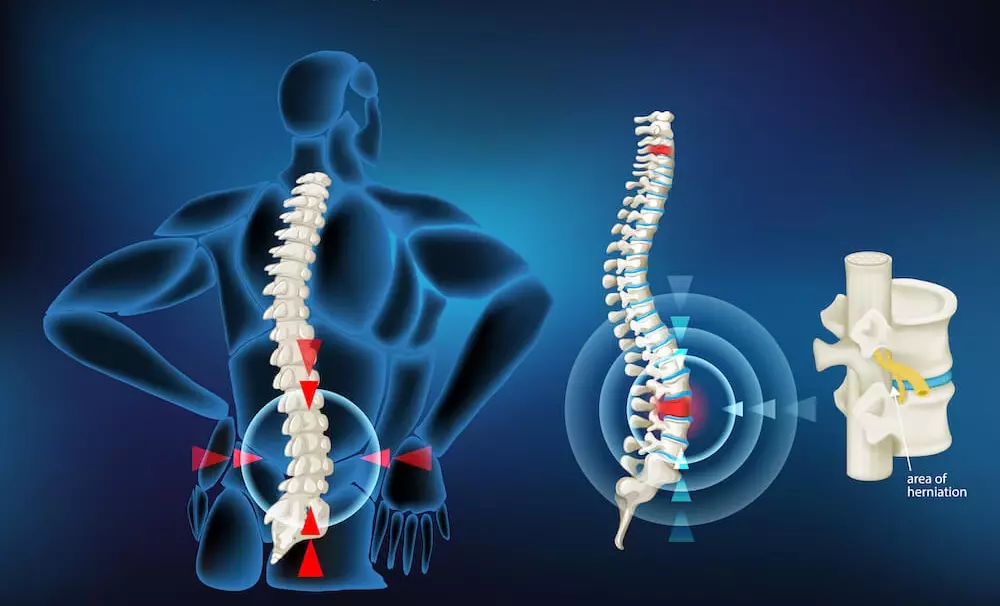 راه‌های تشخیص دیسک کمر