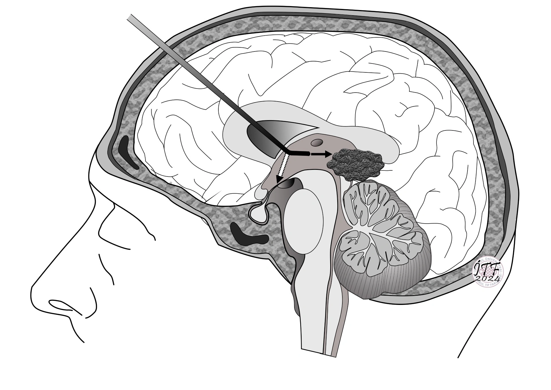آندوسکوپی ونتریکولوستومی سوم
