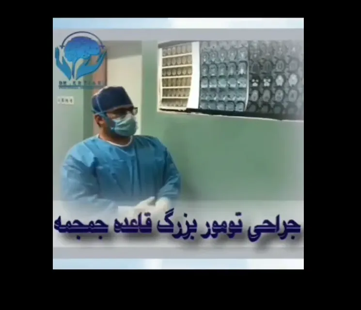 Large skull base tumor surgery video